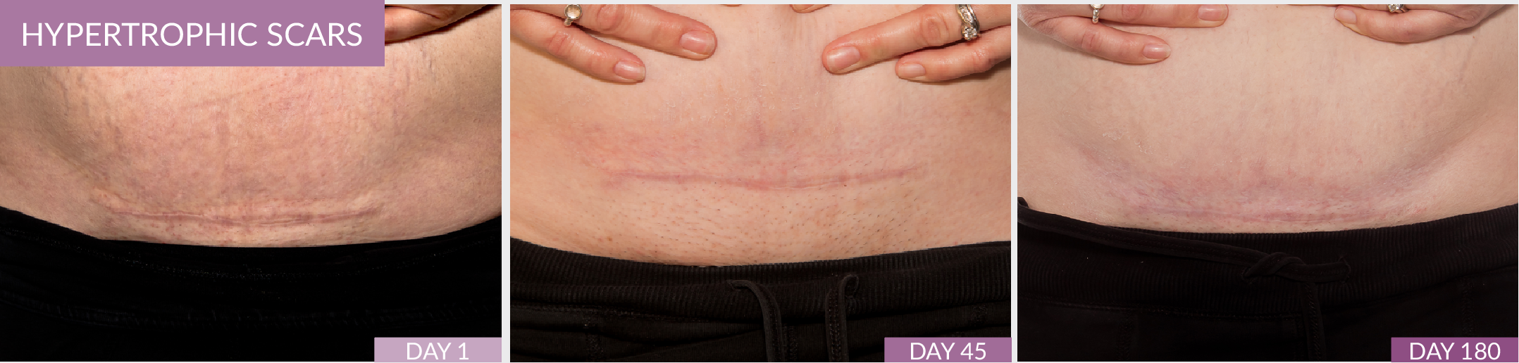 Hypertrophic Scars C-Section Scar Fusion Pharmacy