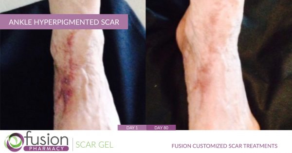 Hyperpigmented Scar Treatment Fusion Specialty Pharmacy