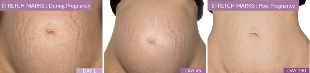 Pregnancy Stretch Marks Scar Gel Fusion Pharmacy